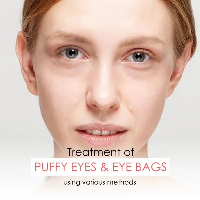 Difference between Eye Bags and Puffy Eyes, Treatments