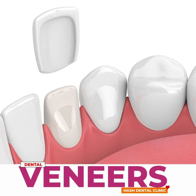 veneers